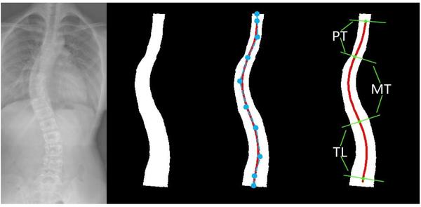 B-Spine: Learning B-Spline Curve Representation for Robust and Interpretable Spinal Curvature Estimation